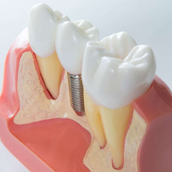 20% popusta na zubne implantate