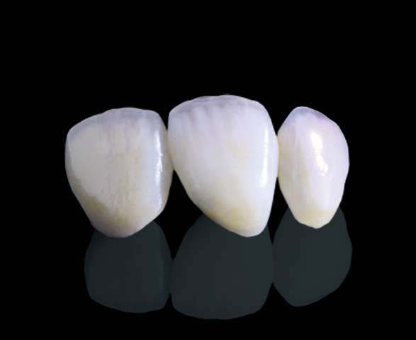 IPS e.max®